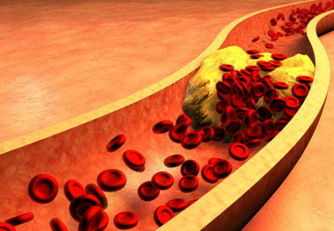 Very low stages of ‘horrific’ ldl cholesterol may enhance stroke risk