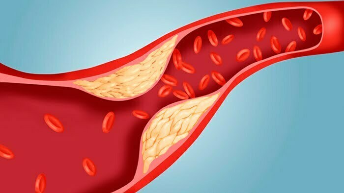 Non-HDL Cholesterol a CV-Risk Crystal Ball for Young Adults