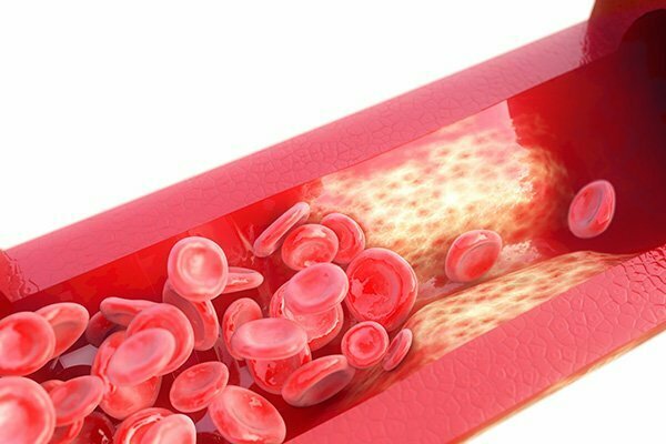 Study Finds Connection Between Genetics and Hypertension Risk