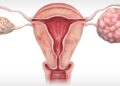 Ovarian Cancer Awareness Month – Get More Attention