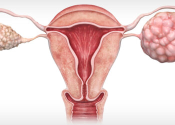 Ovarian Cancer Awareness Month – Get More Attention