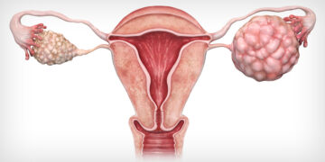 Ovarian Cancer Awareness Month – Get More Attention