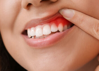 Gum Pain Home Remedies – How to Heal Gum Pain