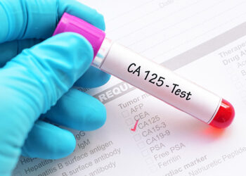 Ca 125 Ovarian Cancer – What Is It?