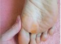 Diabetic Foot Calluses: How to Treat Them
