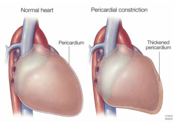 constrictive pericarditis definition