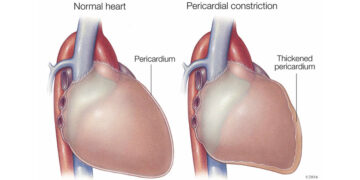 constrictive pericarditis definition